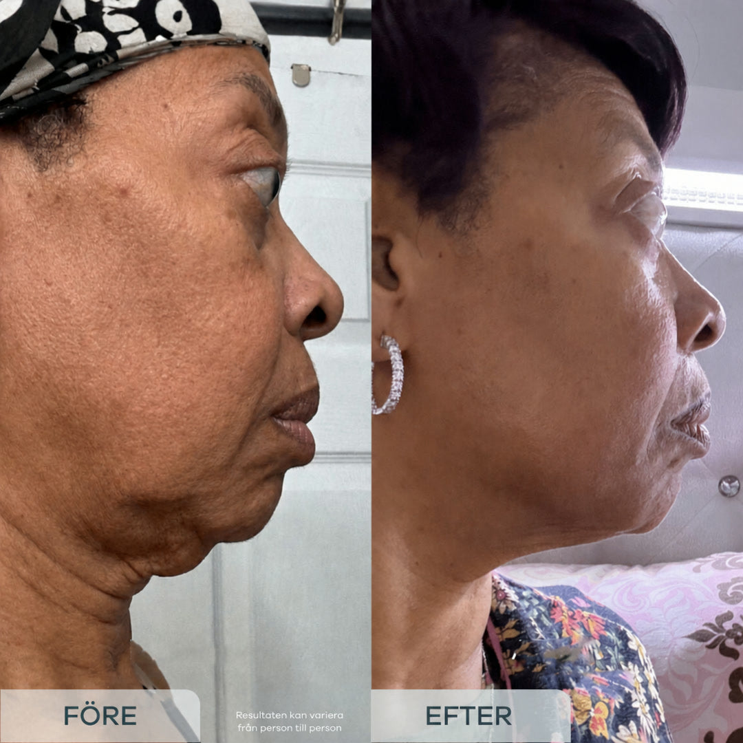 Mikroinfusion före och efter: sidoprofil av en Novacare-kunds kind, käklinje och hals. Resultaten kan variera från person till person