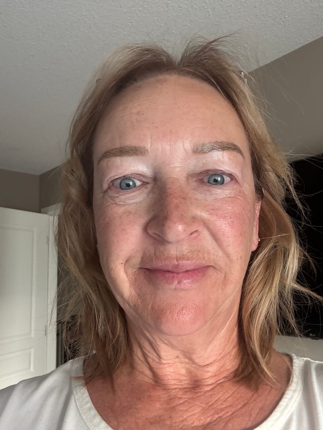 Kundrecension med foto av 3 månaders förbrukning - Novacares mikroinfusionssystem