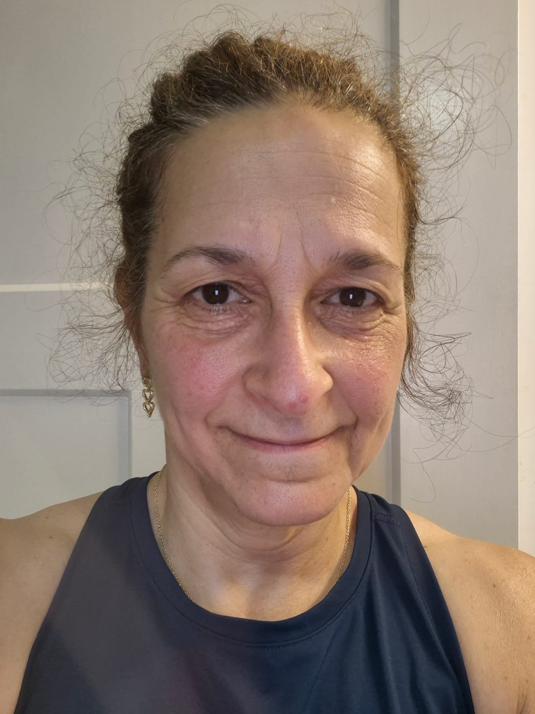 Kundrecension med foto av The Micro Infusion System™ 3 Month | 6 Treatments