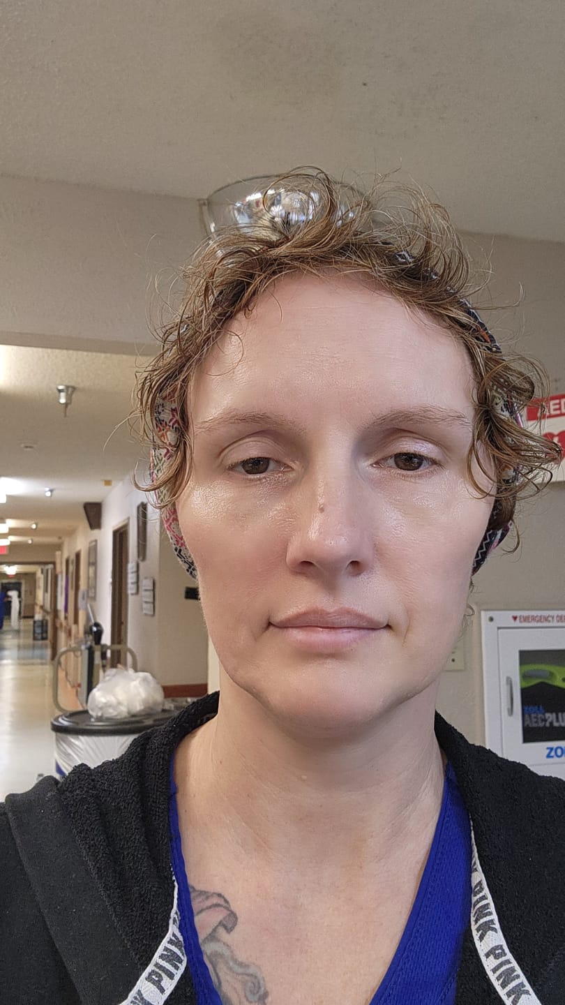Kundrecension med foto av 3 månaders förbrukning - Novacares mikroinfusionssystem