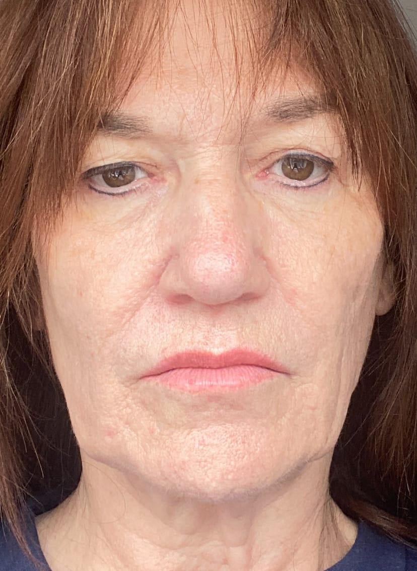Kundrecension med foto av mikronålsinfusionssystemet™