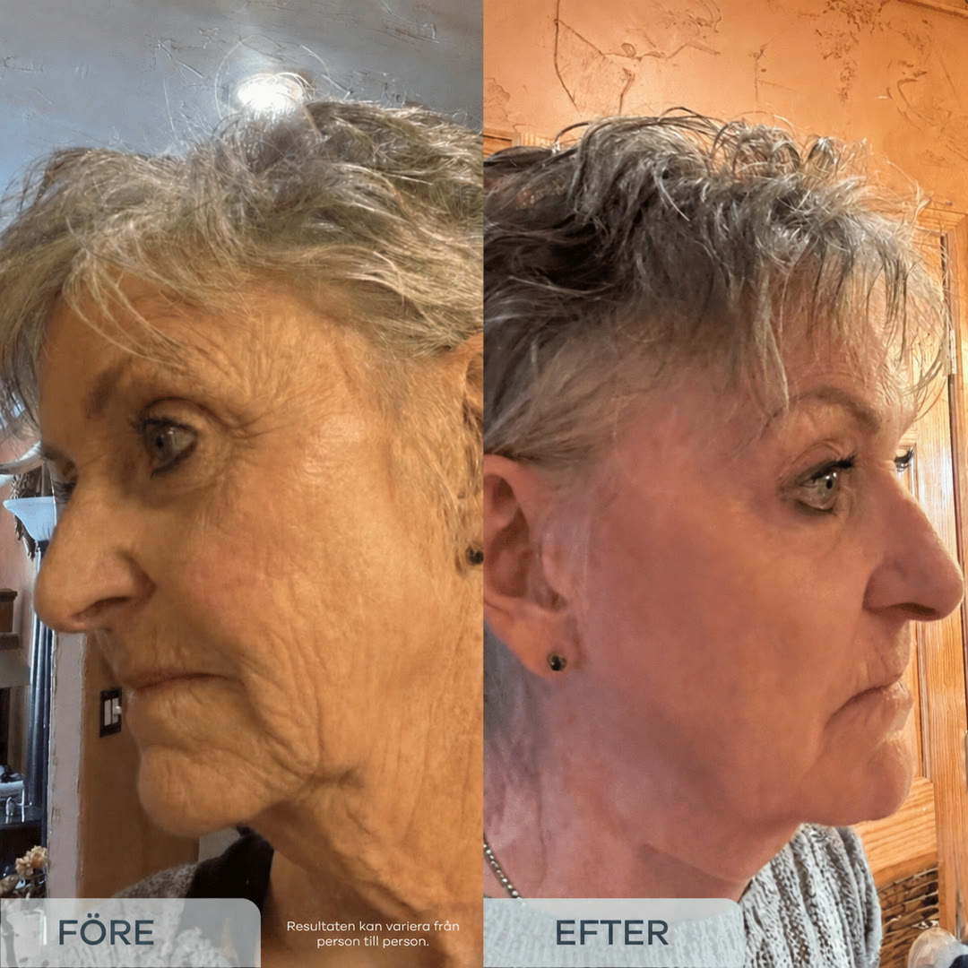 Före och efter mikroinfusion på en Novacare-kunds kind och käklinje. Resultaten kan variera från person till person